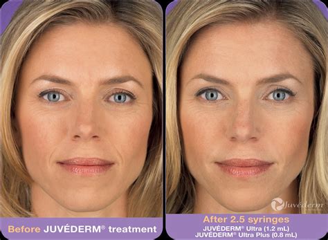 juvederm_before_after - Spa Chiara - Coolsculpting, Botox & Plastic Surgery