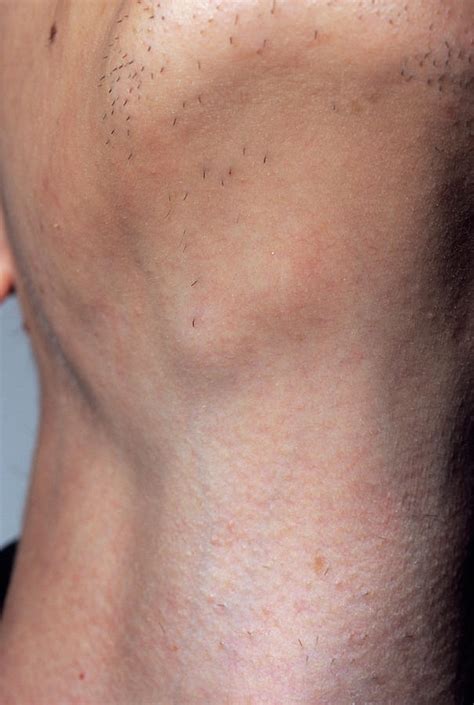 Swollen Glands Photograph by Dr P. Marazzi/science Photo Library