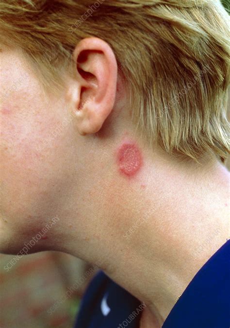 Fungal infection (ringworm) on neck - Stock Image - M270/0110 - Science Photo Library