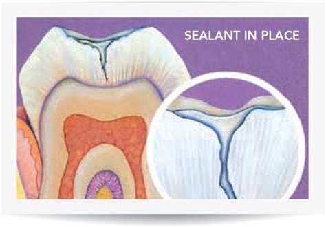 Pit and Fissure Sealants - Impressions Dental Centres