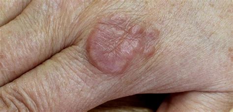 Disease of the Week: Granuloma Annulare - Elect Dermatology