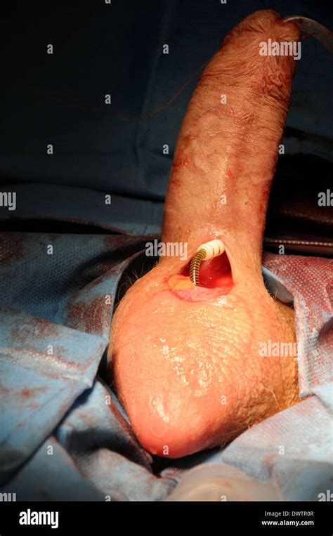 Erection disorder surgery hospital Stock Photo - Alamy
