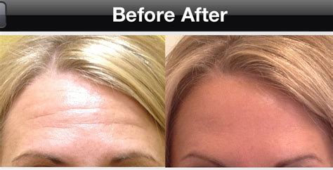 Transform Your Look with Botox: Before and After Inspiration