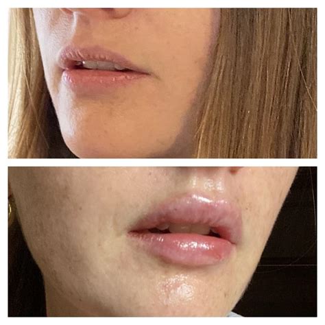 1 2 Ml Lip Filler Before And After | Thebrokensealblog