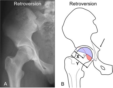 Diagnosis of acetabular retroversion: Three signs positive and increased retroversion index have ...