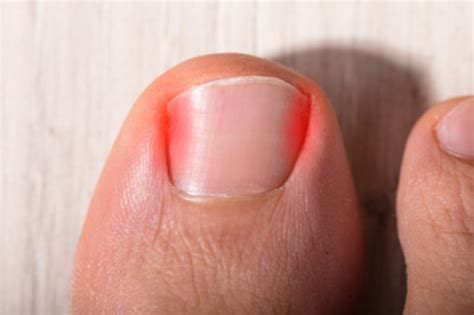 What Is a Nail Avulsion?