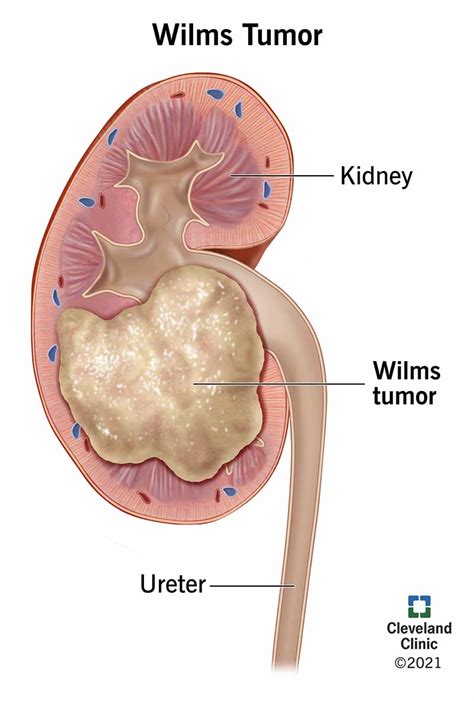 Wilms Tumor: Causes, Symptoms, Prognosis, Treatment