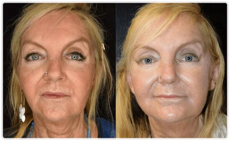 Thread Lift – Face Lift procedures in Toronto & Mississauga | Lip Doctor