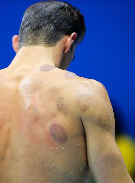 Rio Olympics 2016: What is Cupping Therapy and why is Michael Phelps ...