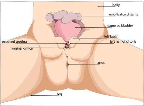 About ECTOPIA VESICAE/EXSTROPHY OF BLADDER-Symptoms,Causes and ...