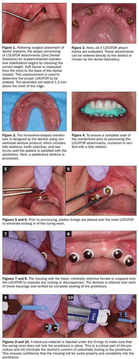 Efficient Chairside Attachment Processing Made Simple - Dentistry Today