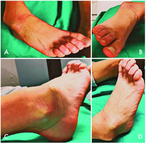 Clinical images of an isolated medial subtalar joint dislocation (STJD)... | Download Scientific ...