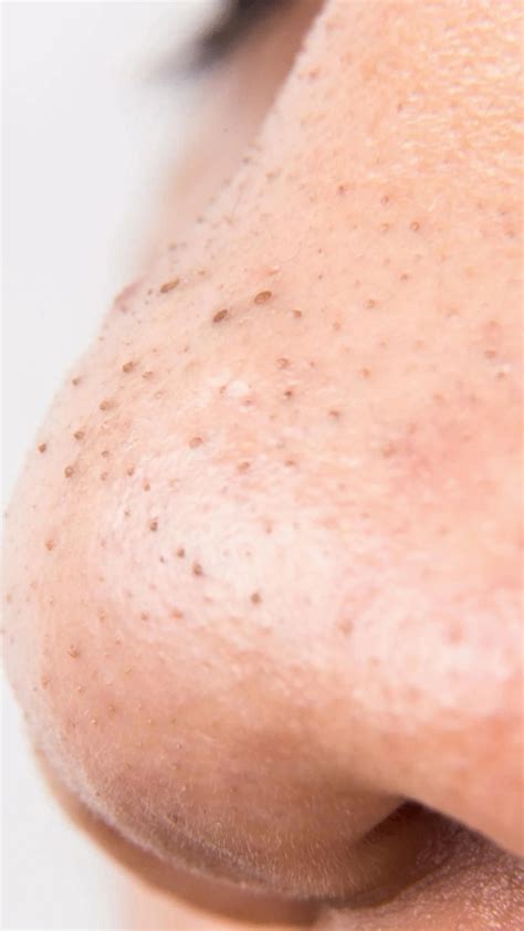 Face Brown Spots Removal - The Right Choice? - Daily Health News | How ...