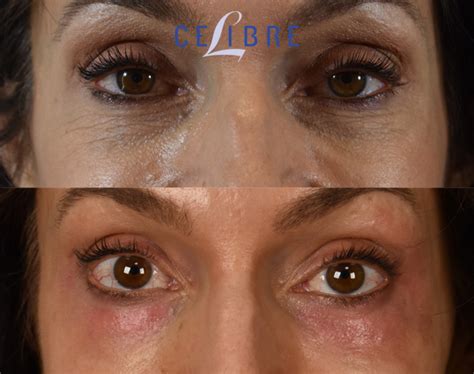 Remove Under Eye Wrinkles Laser Sale | centralcountiesservices.org