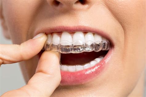 Alternative Types of Braces | Andrew W. Skorobatckyj, DDS | Parma, OH