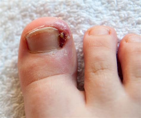 Ingrown Toenails – Auckland Ingrown Toenail Clinic