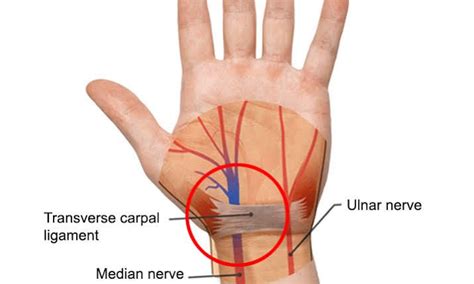 Acupuncture for Carpal Tunnel Syndrome - Pain Relief in Bangkok