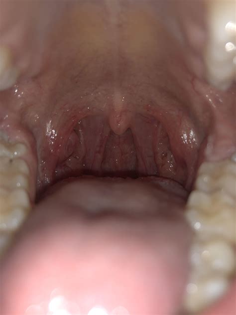 does this just look like tonsil stones? more in comments : r/DiagnoseMe