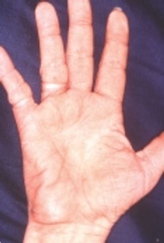 [PDF] The Combination of Tripe Palms, Acanthosis Nigricans and Florid Cutaneous Papillomatosis ...