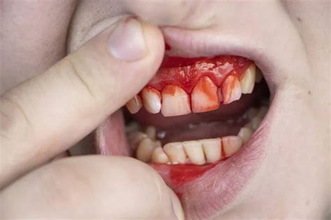 Bruised tooth Stock Photos, Royalty Free Bruised tooth Images | Depositphotos