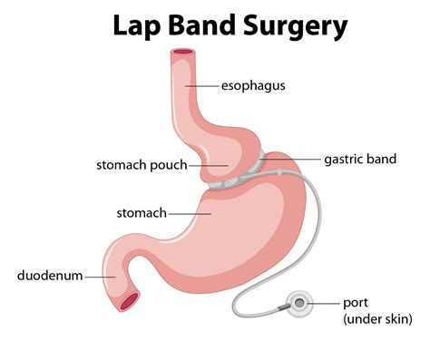 Be aware of Pros & Cons of Lap Band Surgery - Healthy Living Retreats ...