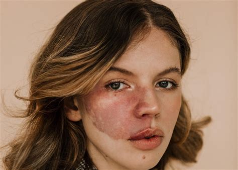 Beautiful from birth: Bullied for birthmark on her face but that didn't ...