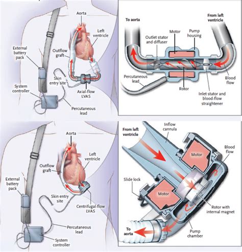 Comparison between types of CF-LVADs: Axial-Flow Pump (HeartMate II ...