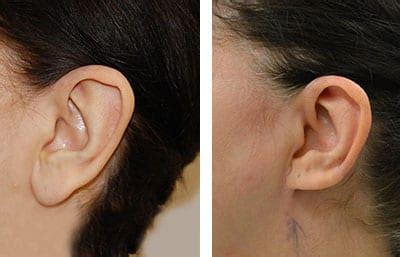 Macrotia Surgery / Ear Reduction | Ear Reconstruction