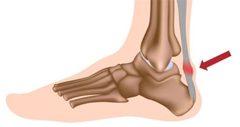 Achilles Tendonitis | Diagnosis, Treatment & Rehabilitation Exercises