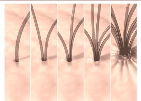 Pili Multigemini Disorder - Causes and Treatment of Multiple Hairs in ...