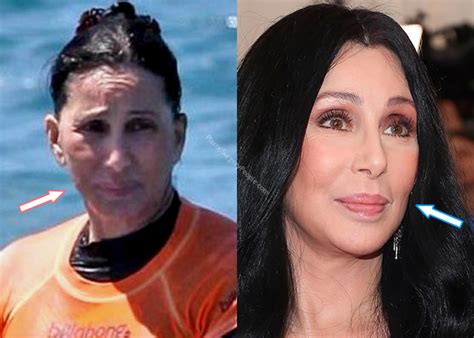 Cher Facelift Before and After Photo Compare | Celebrity plastic ...