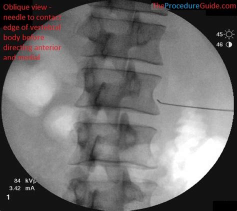 Lumbar Sympathetic Block - Technique and Overview - The Procedure Guide