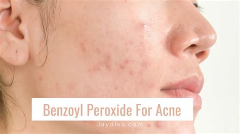 How to Use Benzoyl Peroxide for Acne to See Results - Jaydiva