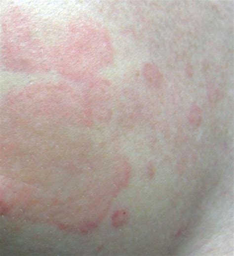 Red Spots On Chest Back And Neck at John Lay blog