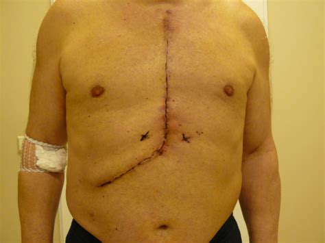 Extended sternotomy. The extended sternotomy incision post-operatively ...