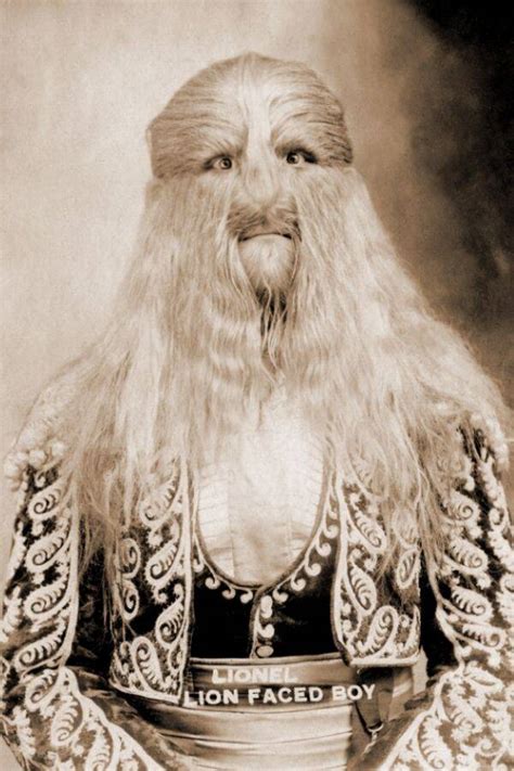 Stephan Bibrowski, A Sideshow Performer Known As The 'Lion-Faced Man'