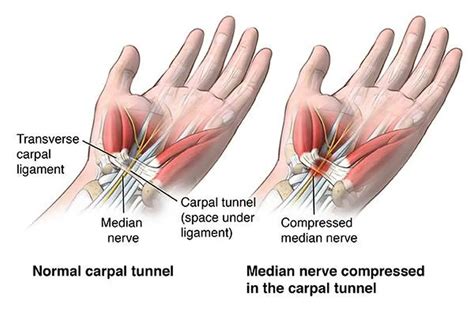 Pictures Of Carpal Tunnel