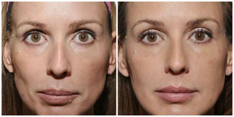 Amazing Before and After Sculptra Photos