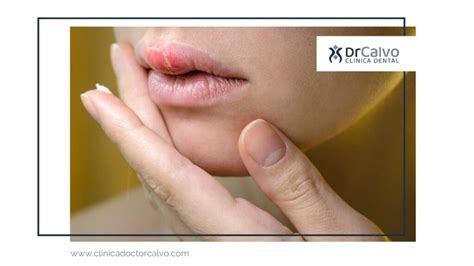 Herpes labial: síntomas, causas y tratamiento | Clínica Doctor Calvo Sevilla