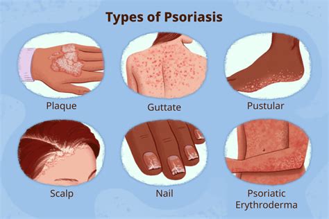 Psoriasis, Symptoms, Causes, Triggers, and Treatment - Ensocure