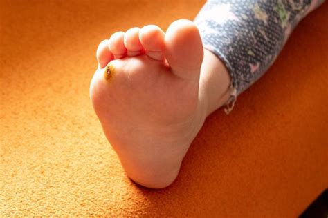 Warts in Children: What You Need to Know: Podiatry Hotline Foot & Ankle: Foot and Ankle Specialists