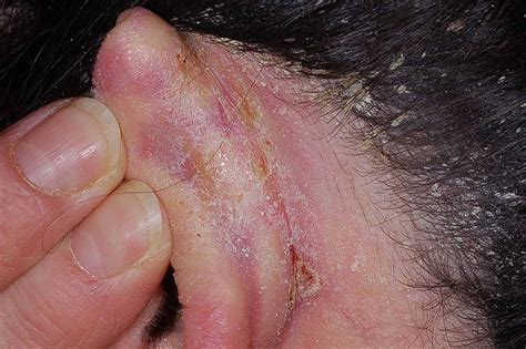 Managing Psoriasis Behind the Ear: Tips for Relief and Prevention ...