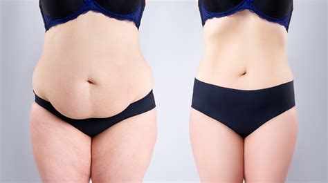 CoolSculpting vs. Liposuction {Cost, Results, Side Effects}