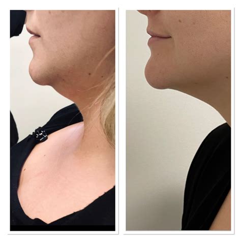 Fat dissolving Injections after 3 sessions - Before & After : r/PlasticSurgery