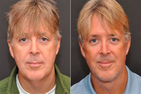 Before And After Plastic Surgery Face - Midland News Update