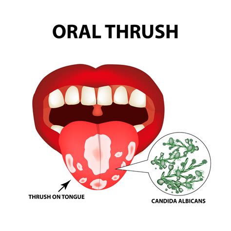 What Is Oral Thrush? | Acorn Dentistry For Kids