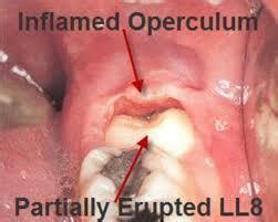 What is Pericoronitis?