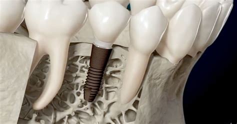 OSSEOINTEGRATION: Cell to Cell Communication - Odonto-Tv