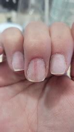 Melanoma Nail Symptoms