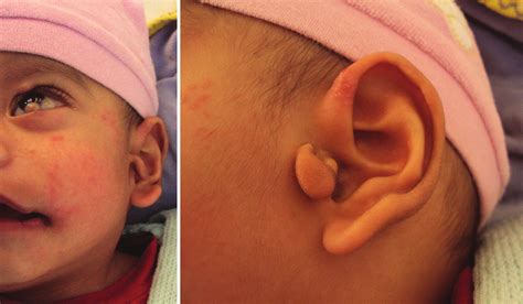 (a) Left bulbar dermoid maxillary and mandibular hypoplasia. (b ...